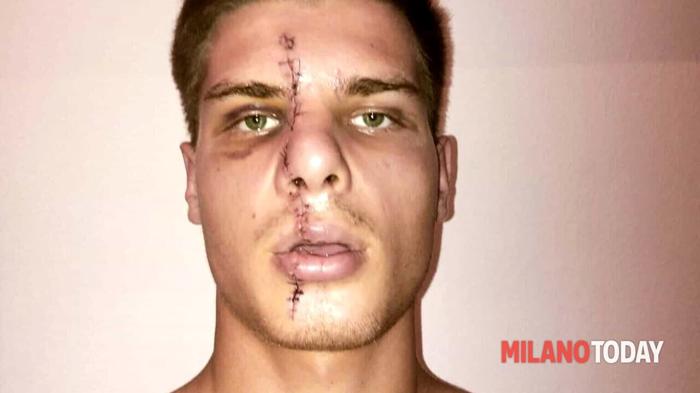 Il ragazzo sfregiato al volto durante una rapina a Milano Ragazzo sfregiato al volto durante una rapina 1