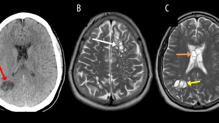 Infezione da tenia nel cervello: il caso di un uomo in Florida