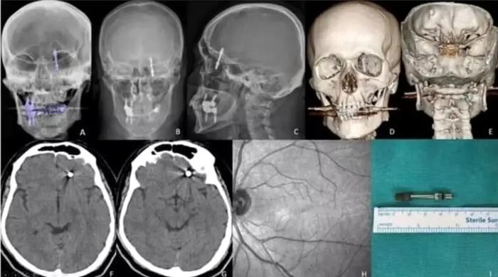 La radiografia di Ramazan Y lmaz (Foto da X, ex Twitter)