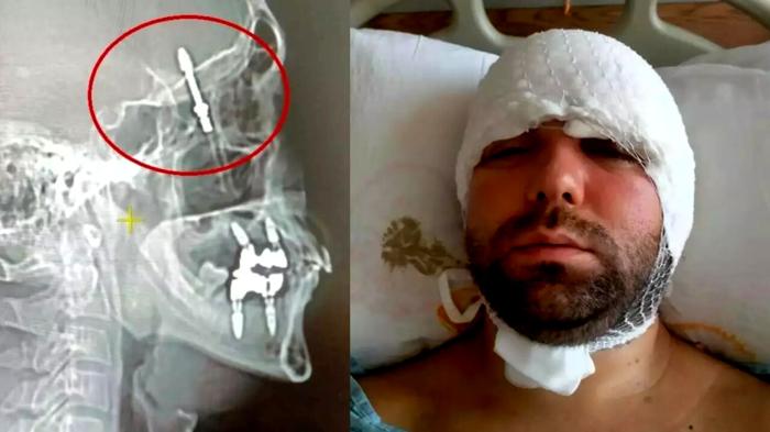 Incubo odontoiatrico: vite perfora cranio durante intervento a Bursa
