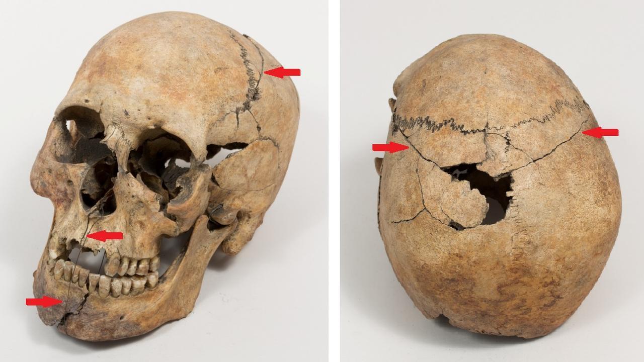 due vedute di un cranio umano che mostrano danni post mortem e ricostruzione