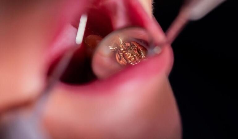 Oro dentale sottratto ai defunti: oltre 8 chili in 11 anni